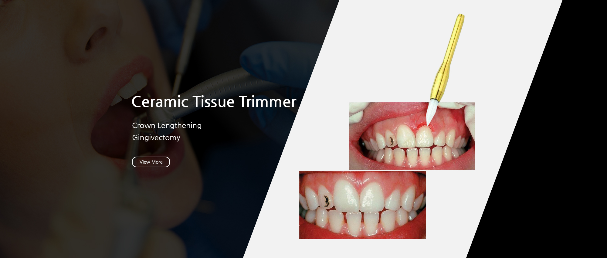 Ceramic Tissue Trimmer